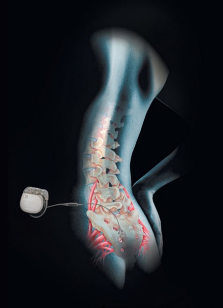 La neuromodulation des racines sacrées