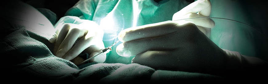 La neuromodulation des racines sacrées