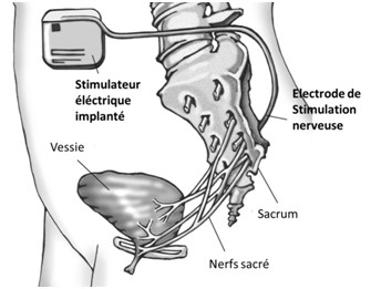 Schema de la neuromodulation chez la femme
