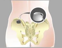 neuromodulation des racines sacrées