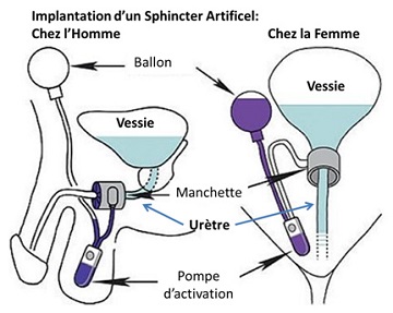 Sphincter artificiel